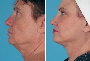 Mini Facelift | Atlanta | Patient 8 | Before and After Photos | Side View | Dr. Marcia Byrd