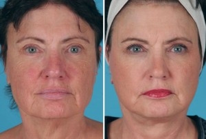 Mini Facelift | Atlanta | Patient 8 | Before and After Photos | Front View | Dr. Marcia Byrd