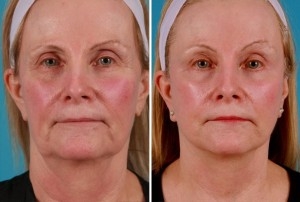 Mini Facelift | Atlanta | Patient 9 | Before and After Photos | Front View | Dr. Marcia Byrd