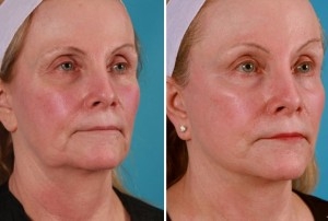 Mini Facelift | Atlanta | Patient 9 | Before and After Photos | Oblique View | Dr. Marcia Byrd