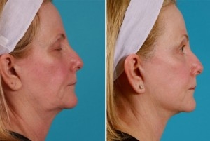 Mini Facelift | Atlanta | Patient 9 | Before and After Photos | Side View | Dr. Marcia Byrd