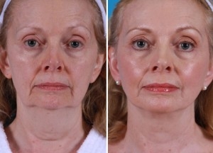 Mini Facelift | Atlanta | Patient 10 | Before and After Photos | Front View | Dr. Marcia Byrd