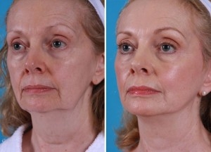 Mini Facelift | Atlanta | Patient 10 | Before and After Photos | Oblique View | Dr. Marcia Byrd