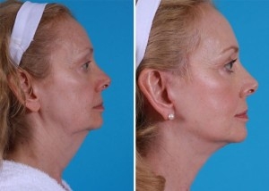 Mini Facelift | Atlanta | Patient 10 | Before and After Photos | Side View | Dr. Marcia Byrd