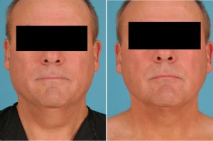 Neck Liposuction | Atlanta | Patient 1 | Before and After Photos | Front View | Dr. Marcia Byrd