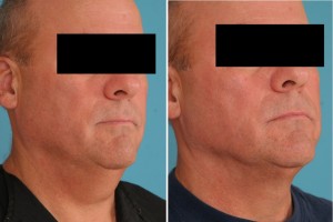 Neck Liposuction | Atlanta | Patient 1 | Before and After Photos | Oblique View | Dr. Marcia Byrd
