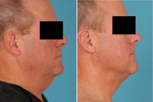 Neck Liposuction | Atlanta | Patient 1 | Before and After Photos | Side View | Dr. Marcia Byrd