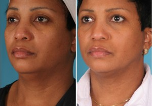 Neck Liposuction | Atlanta | Patient 2 | Before and After Photos | Oblique View | Dr. Marcia Byrd