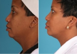 Neck Liposuction | Atlanta | Patient 2 | Before and After Photos | Side View | Dr. Marcia Byrd