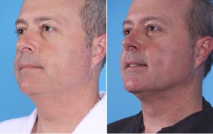 Neck Liposuction | Atlanta | Patient 4 | Before and After Photos | Oblique View | Dr. Marcia Byrd