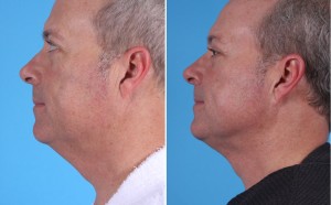 Neck Liposuction | Atlanta | Patient 4 | Before and After Photos | Side View | Dr. Marcia Byrd