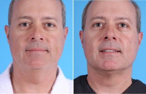 Neck Liposuction | Atlanta | Patient 4 | Before ans After Photos | Front View | Dr. Marcia Byrd