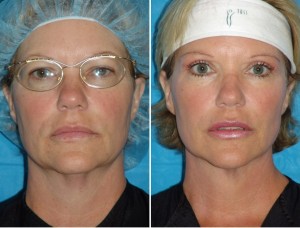 Neck Liposuction | Atlanta | Patient 5 | Before and After Photos | Front View | Dr. Marcia Byrd