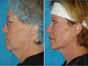 Neck Liposuction | Atlanta | Patient 5 | Before and After Photos | Oblique View | Dr. Marcia Byrd