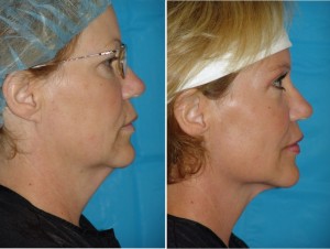 Neck Liposuction | Atlanta | Patient 5 | Before and After Photos | Side View –| Dr. Marcia Byrd