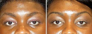 Permanent Makeup | Atlanta | Patient 5 | Before and After Photos | Dr. Marcia Byrd