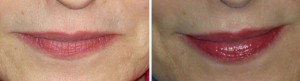 Permanent Makeup | Atlanta | Patient 6 | Before and After Photos | Dr. Marcia Byrd