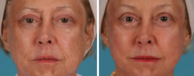 Portrait Plasma | Atlanta | Patient 1 | Before and After Photos | Dr. Marcia Byrd