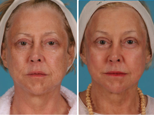 Portrait Plasma | Atlanta | Patient 1 | Before and After Photos | Dr. Marcia Byrd