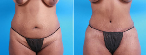 Tummy Tuck | Atlanta | Patient 1 | Before and After Photos | Front View | Dr. Marcia Byrd.jpg
