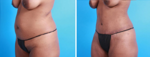 Tummy Tuck | Atlanta | Patient 1 | Before and After Photos | Oblique View | Dr. Marcia Byrd