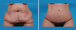 Tummy Tuck | Atlanta | Patient 2 | Before and After Photos | Front View | Dr. Marcia Byrd