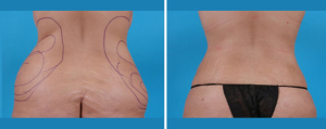 Tummy Tuck | Atlanta | Patient 2 | Before and After Photos | Rear View | Dr. Marcia Byrd