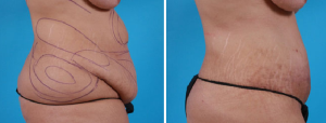 Tummy Tuck | Atlanta | Patient 2 | Before and After Photos | Side View | Dr. Marcia Byrd