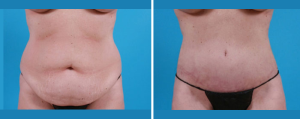 Tummy Tuck | Atlanta | Patient 3 | Before and After Photos – Front View | Dr. Marcia Byrd