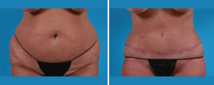 Tummy Tuck | Atlanta | Patient 4 | Before and After Photos | Front View | Dr. Marcia Byrd