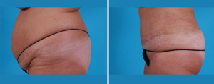 Tummy Tuck | Atlanta | Patient 4 | Before and After Photos | Side View | Dr. Marcia Byrd.jpg