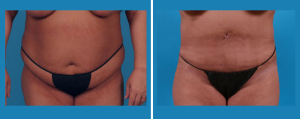 Tummy Tuck | Patient 5 | Front View | Dr. Marcia Byrd