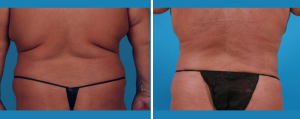 Tummy Tuck | Atlanta | Patient 5 | Before and After Photos | Rear View | Dr. Marcia Byrd