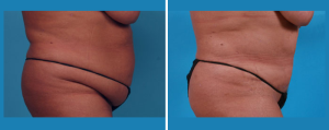 Tummy Tuck | Atlanta | Patient 5 | Before and After Photos | Side View | Dr. Marcia Byrd