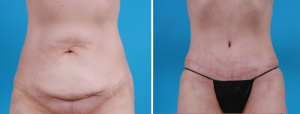 Tummy Tuck | Atlanta | Patient 6 | Before and After Photos | Front View | Dr. Marcia Byrd