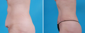 Tummy Tuck | Atlanta | Patient 6 | Before and After Photos | Side View | Dr. Marcia Byrd
