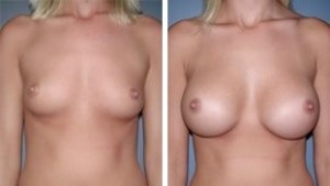 Breast Augmentation | Atlanta | Before and After Photos | Dr. Marcia Byrd