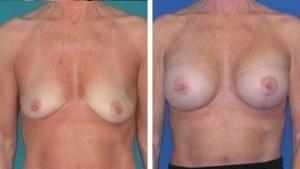 Breast Augmentation | Atlanta | Before and After Photos | Dr. Marcia Byrd