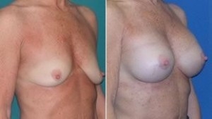 Breast Augmentation | Atlanta | Before and After Photos | Dr. Marcia Byrd