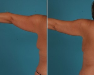 Arm Liposuction | Atlanta | Before and After Photos | Dr. Marcia Byrd