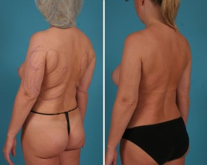 Arm Liposuction | Atlanta | Before and After Photos | Dr. Marcia Byrd