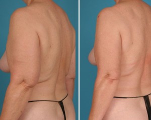 Arm Liposuction | Atlanta | Before and After Photos | Dr. Marcia Byrd