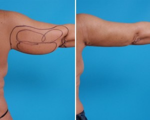 Arm Liposuction | Atlanta | Before and After Photos | Dr. Marcia Byrd