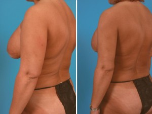 | Atlanta | Before and After Photos | Dr. Marcia Byrd