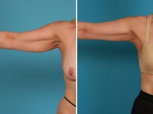 Arm Liposuction | Atlanta | Before and After Photos | Dr. Marcia Byrd