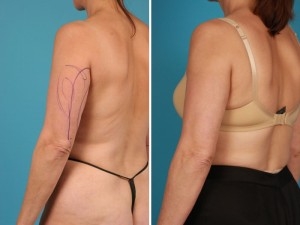 Arm Liposuction | Atlanta | Before and After Photos | Dr. Marcia Byrd