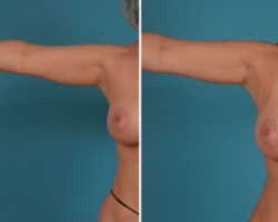 Arm Liposuction | Atlanta | Before and After Photos | Dr. Marcia Byrd