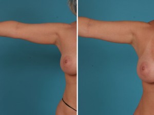 Arm Liposuction | Atlanta | Before and After Photos | Dr. Marcia Byrd