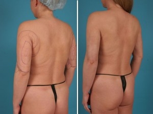 Arm Liposuction | Atlanta | Before and After Photos | Dr. Marcia Byrd