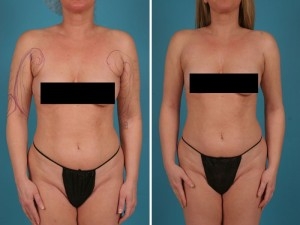 Arm Liposuction | Atlanta | Before and After Photos | Dr. Marcia Byrd